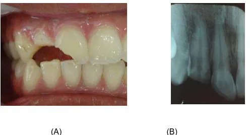 Gambar 1. (A) Foto klinis gigi 12 dan 11 dengan fraktur Ellis kelas III; (B) Radiograf  gigi 12 dan 11 terlihat pulpa terbuka, tidak terdapat radiolusen di  regioperiapikal                                                          