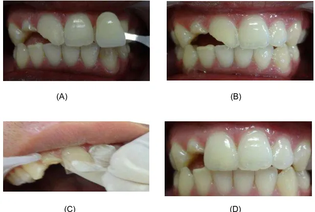 Gambar 2. Tahapan perawatan saluran akar gigi 12. (A) Radiografis pengukuran panjang kerja; (B) Pengepasan guta perca utama; (C) Pengisian saluran akar dengan teknik kondensasi lateral; (D) radiografis pengisian saluran akar