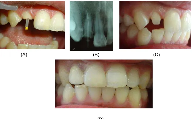 Gambar 4.                                                                                                (D)  Tahap restorasi mahkota jaket porselin fusi metal dengan pasak fiber pada gigi 12