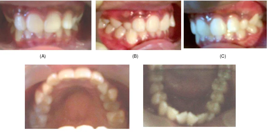 Gambar 3. Fotogram cetakan gigi pasien (A) rahang atas (B) rahang bawah 