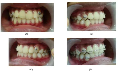 Gambar 14. Fotogram Intraoral gigi pasien 18 bulan setelah perawatan (A) tampak depan (B) samping kanan (C) samping kiri (D) rahang bawah (E) rahang atas 