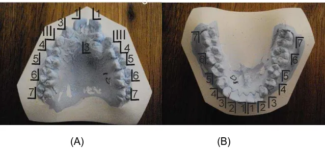 Gambar 1 (A) (B) Model gigi awal Rahang Atas dan Rahang Bawah 