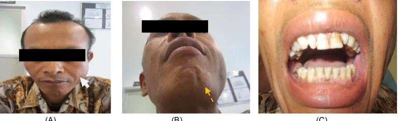 Gambar 1. (A) Gambaran klinis pasien tampak pipi kiri mengalami deformasi (B) Gambaran worm view terlihat asimetris wajah (C) Gambaran klinis intra oral tidak terlihat perbedaan dengan kontralateral daerah lesi