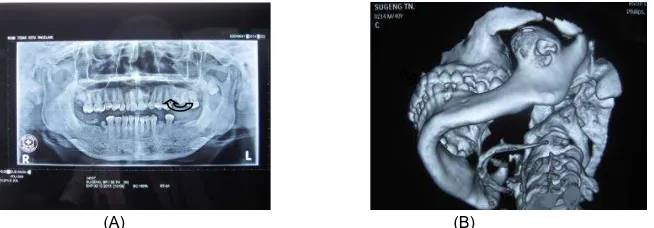 Gambar 2. (A) Gambaran radiologi menunjukkan adanya molar ketiga ektopik di coronoid; (B) Gambaran 3 dimensi menunjukkan kerusakan tulang disekitar coronoid sinistra karena desakan lesi kista  