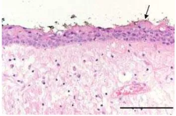 Gambar 1. Gambaran mikroskopik epitelium dinding kista yang  dilapisi reduced enamel epithelium (tanda panah).3 