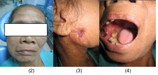 Gambar 2. Gambaran klinis ekstra oral berupa pembengkakan pipi kanan, 3.  Fistel ekstra oral (tanda panah), 4
