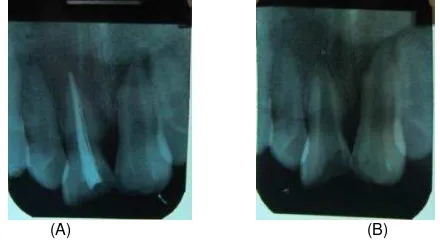 Gambar 1. Foto awal gigi 1.1 dan 2.1, terdapat fraktur elis klas II pada gigi 2.1 dan fraktur elis klas III pada gigi 11 dengan diskolorasi gigi