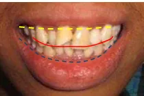 Gambar 4 . Gambaran klinis saat senyum aktif (moderate smile). 