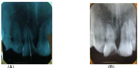 Gambar 7. (A) Pengukuranpanjang kerja pada gigi 11 menggunakan K-File #15; (B) Radiograf gigi 11, tampak saluran akar dengan 