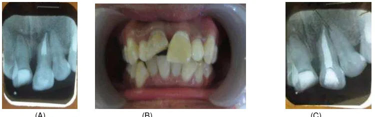 Gambar 8. Perawatan saluran akar gigi 21, (A) Hasil obturasi; (B) Hasil restorasi resin komposit gigi 21; (C) radiograf gigi 21 setelah direstorasi dengan pasak dan resin komposit