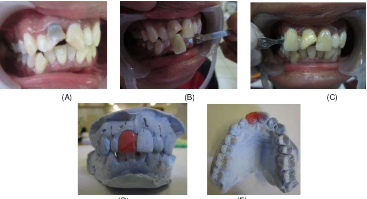 Gambar 10. Perubahan warna gigi 11 saat pertama kali datang sampai perawatan saluran akar selesai dilakukan; a) Gigi 11 perubahan warna gigi menjadi coklat kekuningan lebih gelap dari C4, c) Kontrol sebelum perawatan saluran akar, tampak gigi berwarna cokl