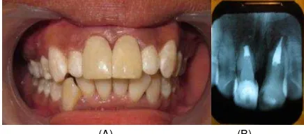 Gambar 11. Hasil veneer direk gigi 11 dan 12 tampak frontal (A), tampak sagital (B,C) dan oklusal (D) 