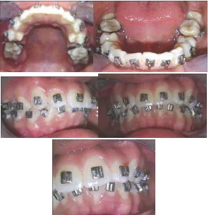 Gambar 8.  Foto Intraoral gigi pasien 9 bulan setelah perawatan, gigi 13,23 dan 33 yang ektopik telah terkoreksi