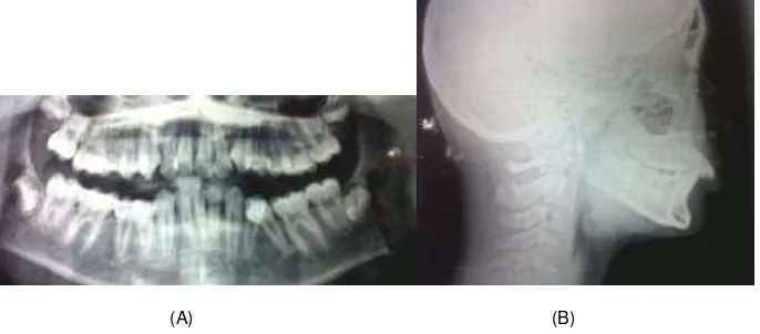 Gambar 1.  Fotografi   ekstraoral   pasien   sebelum  perawatan, (A) Tampak  samping, (B) Tampak  depan, (C) Tampak depan 