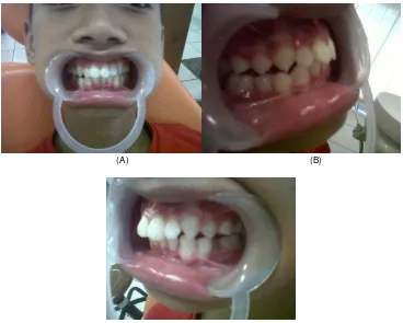 Gambar 7(A)                                                        (B) . Foto  intraoral pasien (6 bulan setelah perawatan), (A) Rahang atas pada cermin  intraoral, (B)  Rahang bawah 