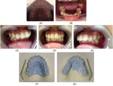 Gambar 2. Foto intraoral dan cetakan gigi pasien. (A) Foto intraoral rahang atas. (B) Foto intraoral rahang bawah