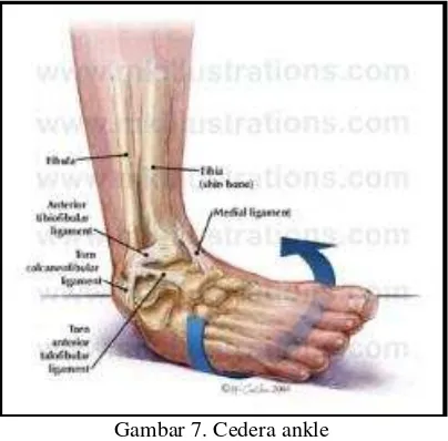 Gambar 7. Cedera ankle  