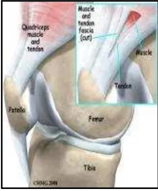 Gambar 9: cedera tendinitis patellar (sumber: Ali Satia Graha, 2012: 42. http//Staffuny.ac.id) 