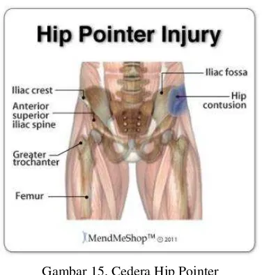 Gambar 15. Cedera Hip Pointer 
