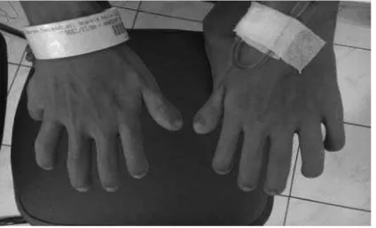 Figure 1. Polydactyly at the hands with sausage-shaped ﬁ ngers