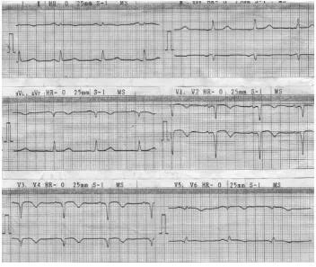 Figure 3. ECG record revealed an old myocardial infarction (I, avL, dan V1-V5). 