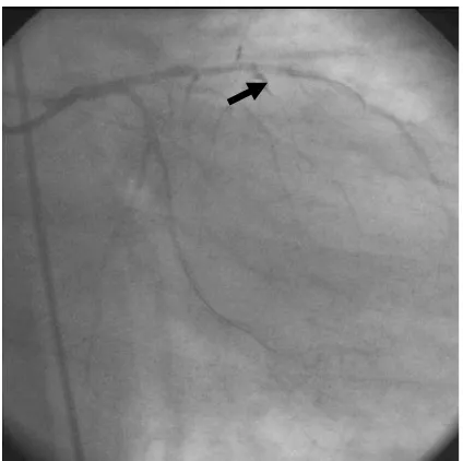 Figure 4. Second coronary angiography as compared to the ﬁ rst one at the time of primary PCI A