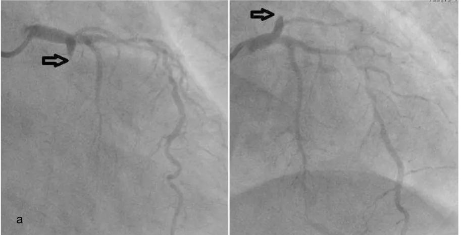 FIGURE 1. ECG recording on admission show ST depression in V2-V5