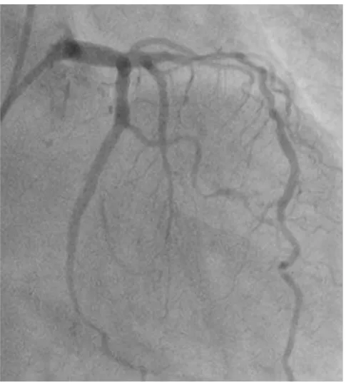 FIGURE 3. Coronary angiography post PCI show ﬂ ow in LCx (arrow)