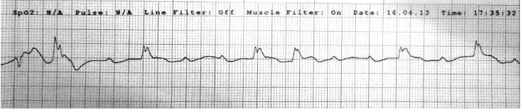 FIGURE 1.  Electrocardiographic (ECG) showed 
