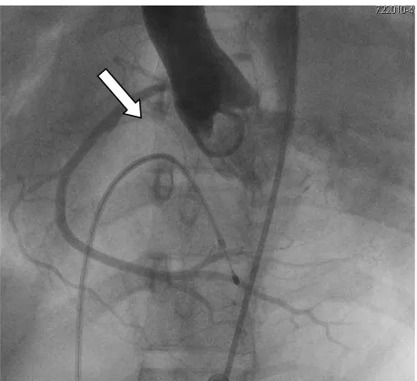 FIGURE 5. Angiography in RAO-caudal view 20/20 looks thrombus (arrow) running from the proximal (A) to the distal LAD and LCX (B)