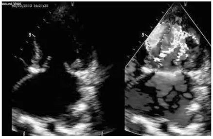 FIGURE 6. TTE parasternal long axis position while diastolic (left) and systolic (right), where the anatomy of the mitral valve posterior leaﬂ eat (PML) seemed stiff, with prolapse of the anterior mitral leaﬂ eat (AML), but not the typical hockey stick picture appearance like in mitral stenosis caused by rheumatic disease.