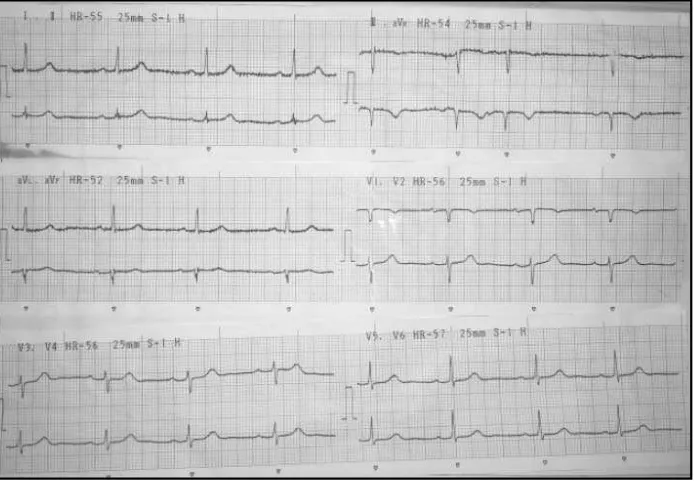 Figure 1. Electrocardiogram showed sinus rhythm with heart rate was 55 beats perminute.