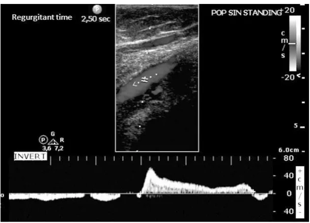 Figure 2. Pulse wave Doppler (DUS) examination showed a reﬂleft popliteal vein after compression distal to the vein (squeeze distal)