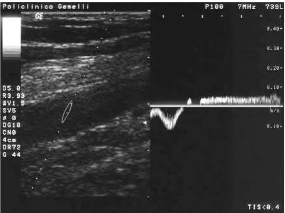Figure 6. Doppler reflux pulse wave examination result with compression maneuver.13