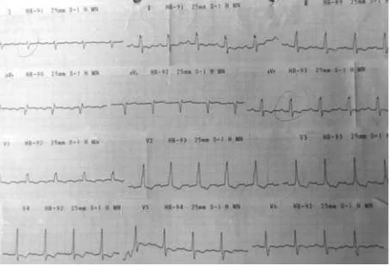 Figure 1. The electrocardiogram (ECG) showed sinus rhythm with a heart rate frequency of 91 x/min, right axis deviation, right ventricular enlargement with right ventricular strain and incomplete right bundle branch block.