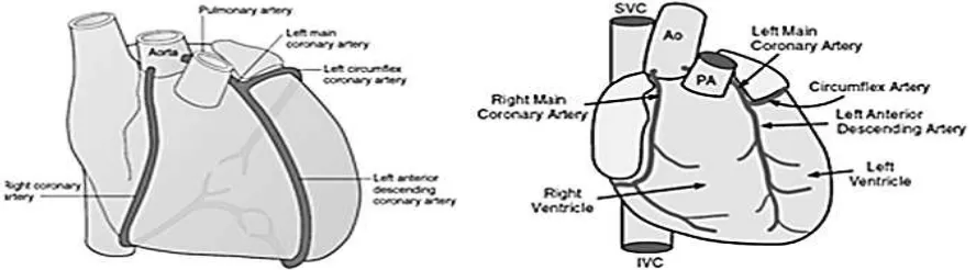 Figure 1. Right and left coronary arteries exiting from aorta, right above the aorta valve
