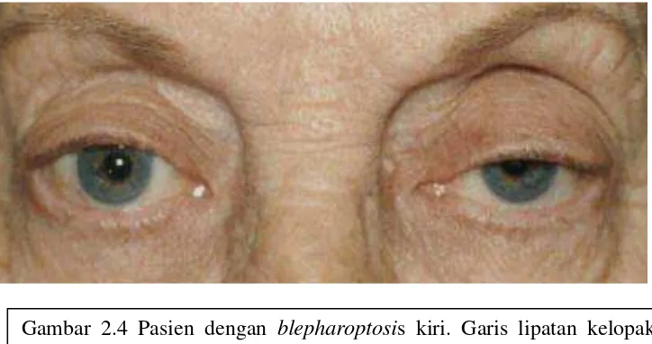 Gambar 2.4 Pasien dengan  Lid crease) tidak terlihat pada mata kiri pasien.  Defek pada sulkus superior terlihat pada kedua mata pasien, dan pasien berusaha   blepharoptosis kiri
