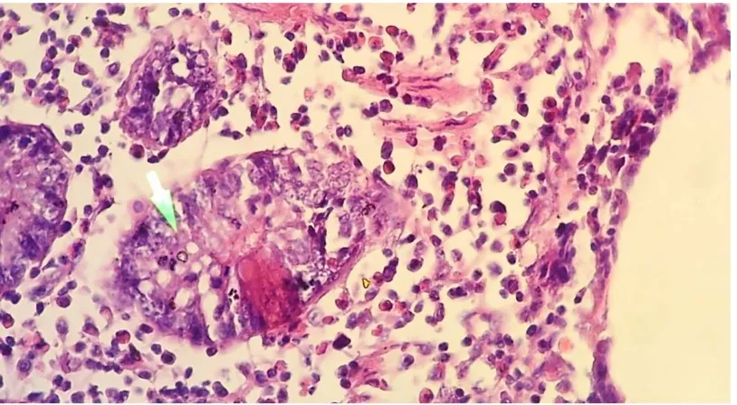 Gambar 3. Gambaran histopatologis organ ceca tonsil itik. Sel mengalami degenerasi dan nekrosis, serta banyak ditemukan sel radang polimorfonuklear (PMN)