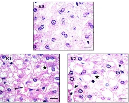 Gambar  2  Gambaran histopatologi hati menunjukkan degenerasi hidropik (tanda panah) dan degenerasi lemak (*)