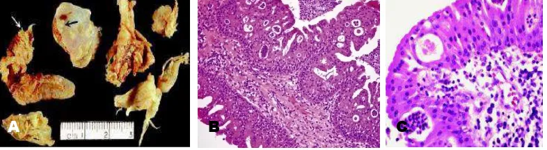 Gambar 2.2 Oncocytic papilloma. A. Gambaran makroskopis, tampak pertumbuhan exophytic  (panah putih) dan inverted (panah hitam)