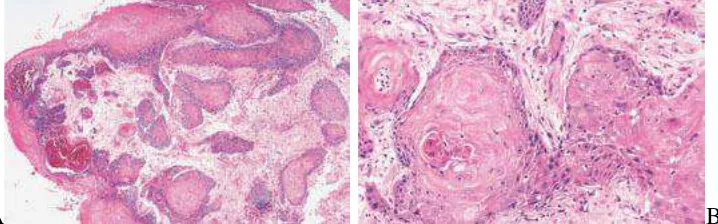 Gambar 2.5.  Gambaran sitologi karsinoma sel skuamous, inti pleomorfik, kromatin kasar, batas sel jelas, sitoplasma kebiruan.12  