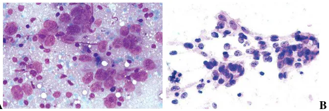 Gambar 2.7. Gambaran sitologi undifferentiated carcinoma. Kelompokan sel-sel epitel undifferentiated, dengan inti vesikuler, nukleoli menonjol dan sitoplasma pucat dan rapuh,  dengan latar belakang limfosit.(A