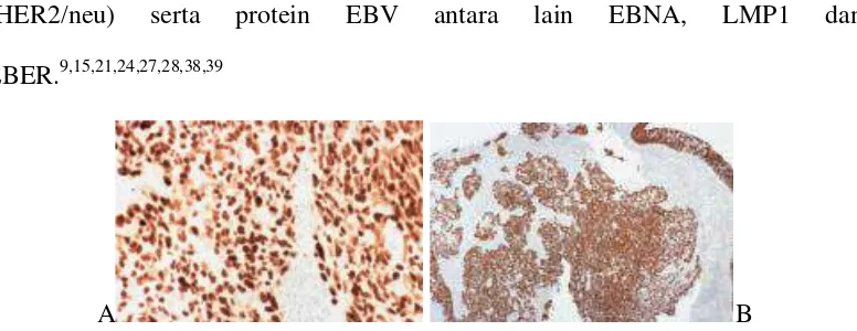 Gambar 2.14. Pewarnaan imunohistokimia pada pada semua inti sel tumor (menunjukkan reaksi positif pada epitel permukaan dan pada kelompokan ireguler sel-sel undifferentiated subtypenonkeratinizing carcinoma 