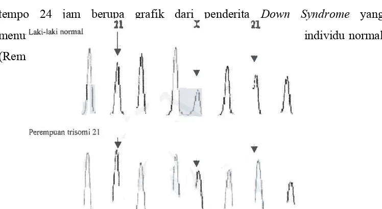 Gambar 2.1 Susunan kromosom pada Down Syndrome menunjukkan trisomi 21