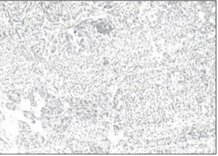 FIGURE 3. Microscopic feature of pancreatoblastoma(HE staining, 400X)