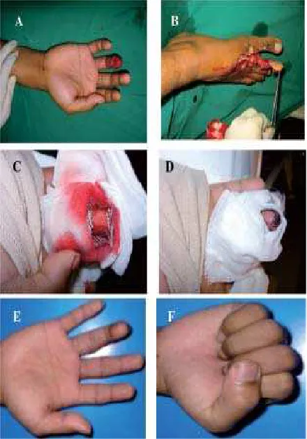 FIGURE 1. Case 1, the crushed palmar side skin and soft-tissue of fourth finger of the right hand (A), free pulptransfer from fibular side of great toe of the right foot (B),appearance in the first week (C and D), and 4 month aftersurgery (E and F)
