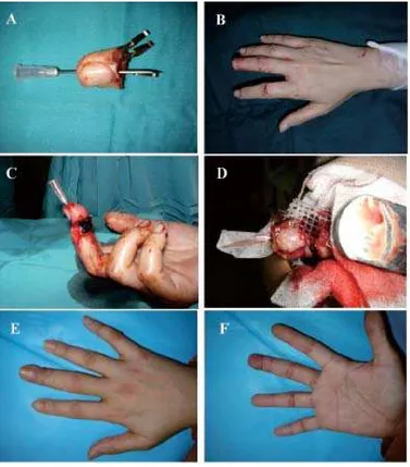 FIGURE 2. Case 2, clean cut amputation at the distal part of distal interphalangeal joint (A and B), replantation in the first 16hours after injury and oozing from the vein backflow (C and D), appearance after 2 months follow up (E and F).Courtesy: Chaula S.