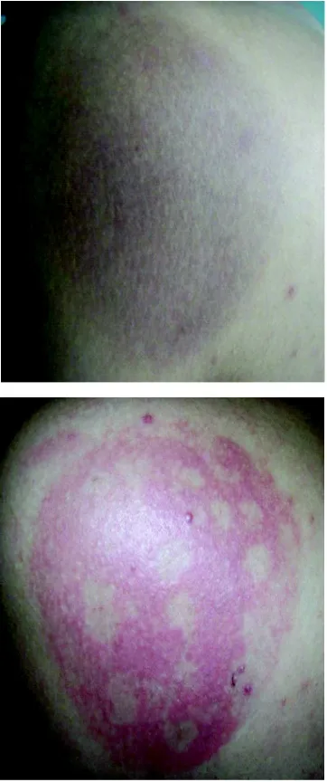 FIGURE 1.FDE lesion before and aftersystemic provocation test