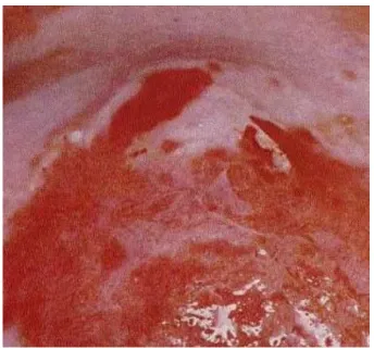 FIGURE 10. The appearance of Strawberry spot in Trichomoniasis infection (left), and purulent discharge and Nabothian cyst (b) in cervicitis (a) (right)14
