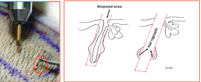 FIGURE 3. Follicular Unit Extraction Follicular unit extraction (red-circle) (left), leave a part of bulge area as a source for hair regrowth (right)